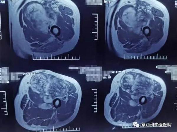 ​怒江州中医医院肿瘤科成功完成一例左下肢软组织恶性肿瘤切除术(图2)