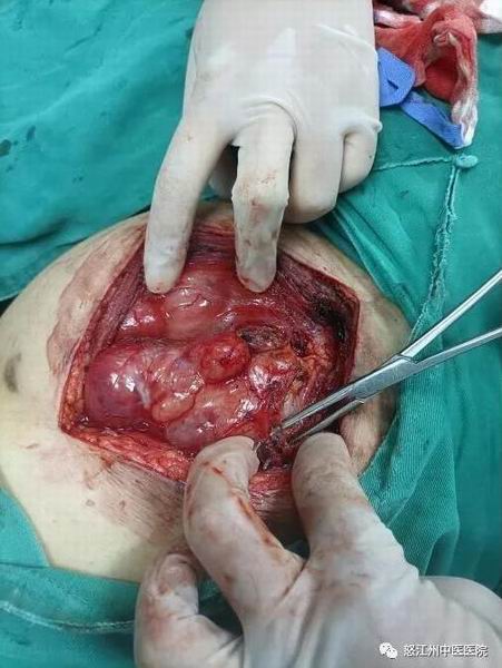 ​怒江州中医医院肿瘤科成功完成一例左下肢软组织恶性肿瘤切除术(图4)