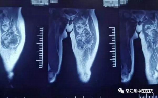 ​怒江州中医医院肿瘤科成功完成一例左下肢软组织恶性肿瘤切除术(图3)