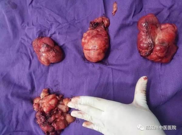 ​怒江州中医医院肿瘤科成功完成一例左下肢软组织恶性肿瘤切除术(图5)